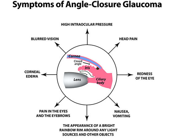 The symptoms of closed angle glaucoma