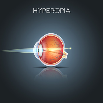Farsightedness Hyperopia
