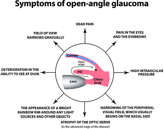 Symptoms of open-angle glaucoma