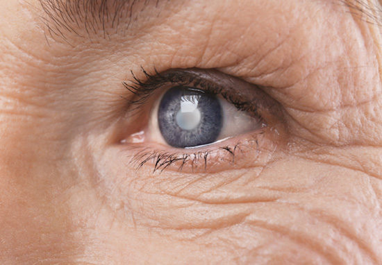 Close up of senior woman with cataract